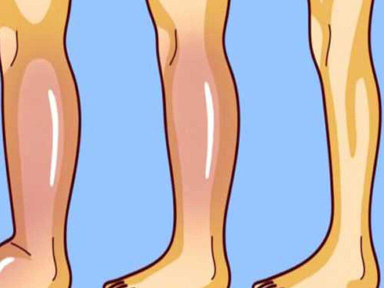 Κατακράτηση υγρών: Τροφές που ανακουφίζουν από την δυσάρεστη αίσθηση