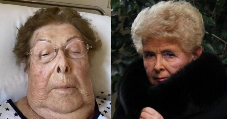 «Μελάνιασαν ξαφνικά τα χέρια μου, άνοιξαν πληγές»: Σοκάρει η Βέφα Αλεξιάδου για την κατάσταση της υγεία της