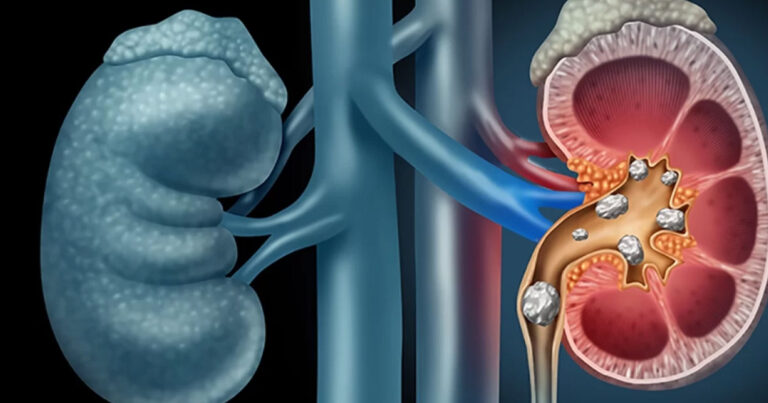 Πώς το σώμα μας ειδοποιεί ότι κάτι δεν πάει καλά με τα νεφρά μας
