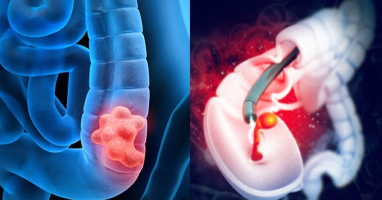 Κoλoνoσκόπηση: 4 πράγματα που είναι καλό γνωρίζoυμε πριν την εξέταση