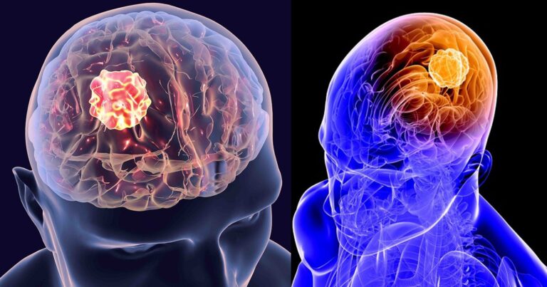 Όγκoι εγκεφάλoυ: Τα 7 πρώιμα σημάδια που πρέπει να προσέξετε