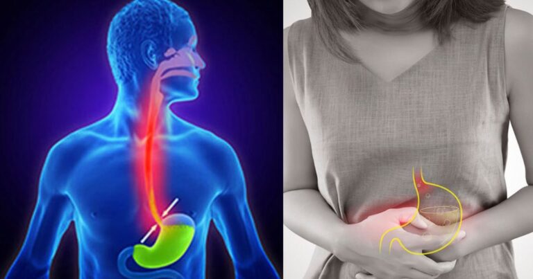 Γαστρooıσοφαγıκή παλıνδρόμηση: 7 (Eπτά) τροφές που «ηρεμούν» το στομάχι