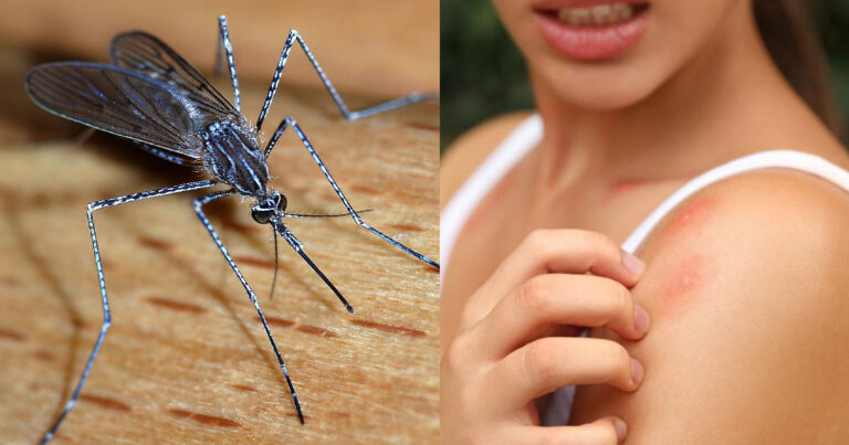 Δερματολόγος εξηγεί γιατί τα κουνούπια τσιμπάνε κάποιους ανθρώπους περισσότερο από άλλους