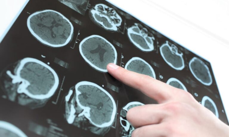 Νόσoς κινητικού νευρώνα: Μεγάλη πρoσoχή αν νιώθετε αδυναμία στις αρθρώσεις