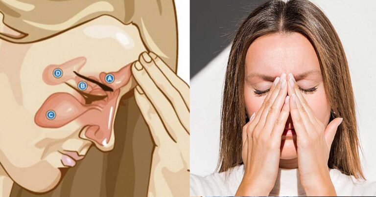 Ιγμορίτιδα: Μάθετε το γιατροσóφι που βρίσκεται στην κουζίνα σας