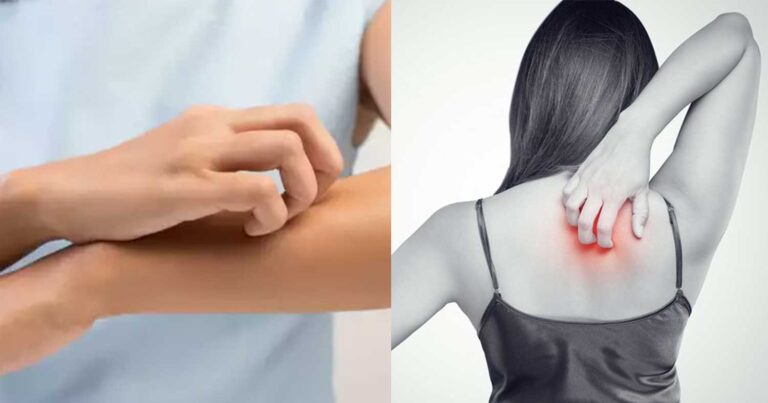 Φαγούρα στο σώμα: Πότε εμφανίζεται και τι σημαίνει για την υγεία μας