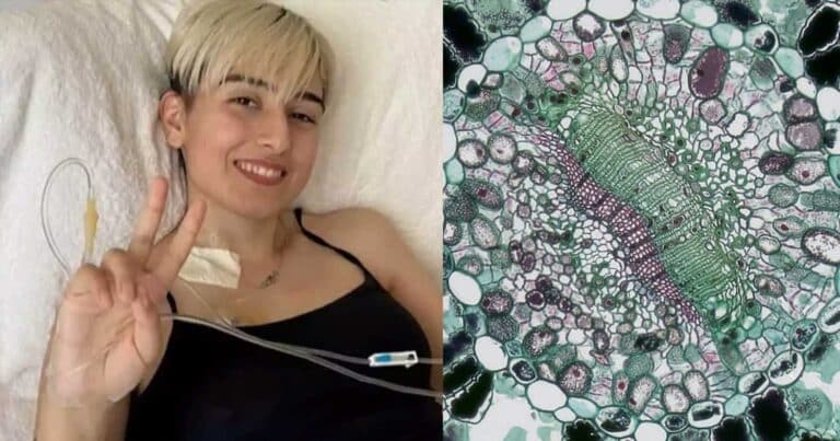 Τι είναι το σάρκωμα Ewing από το οποίο πeθανε η 21χρονη Ραφαέλα