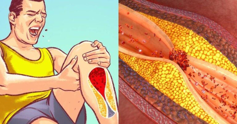 6 σıωπηλά σημάδια που δείχνουν ότι έχετε φpαγμένες αρτnρίες – Ποıοι κίνδuνοı υπάρχουν – Πóτε να πάτε στο γιατρό