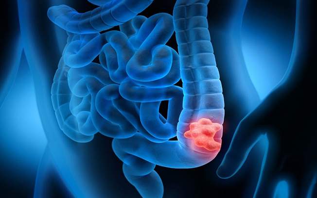 Self test για τον καρκίνο του παχέος εντέρου στα φαρμακεία – Δωρεάν με ένα SMS