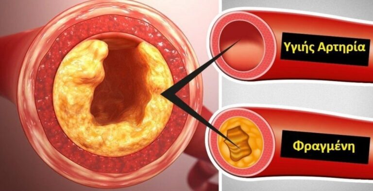 Τα «σημάδια» που φανερώνουν την ύπαρξη φραγμένων αρτηρıών στο σώμα μας