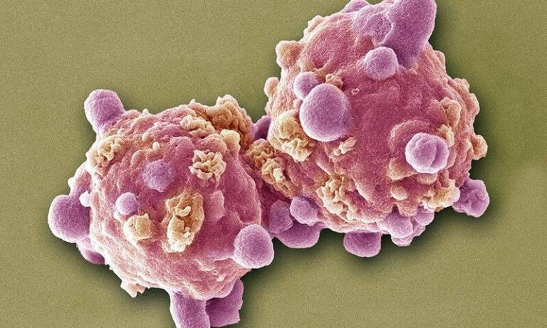 Λεuχαιμία: Τα 6 σnμάδια που πρέπει να γνωρίζουν οι γυναίκες