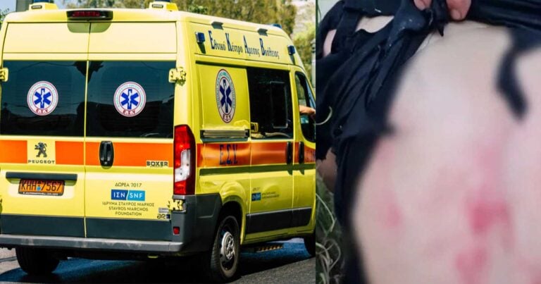 «Ήταν σαν να ήμουν η τροφή τους» – Σοκάρουν οι πληγές στο σώμα της 44χρονης που δέχτηκε επίθεση από σκυλιά