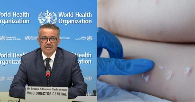 Ο ΠΟΥ κήρυξε παγκόσμια κατάσταση έκτακτης ανάγκης: Τα συμπτώματα και οι χώρες που έχει εμφανιστεί η νόσος