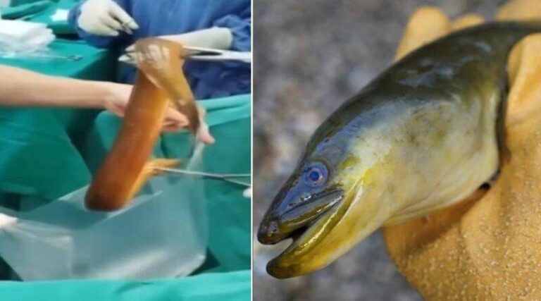 Γιατροί έβγαλαν μέσα από τον πρωκτό ασθενούς ένα ζωντανό χέλι 63 εκατοστών