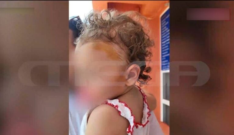 Άγρια επίθεση από αδέσποτο σκύλο: Άρπαξε βρεφάκι 17 μηνών από το κεφάλι – Σε σοκ η μητέρα