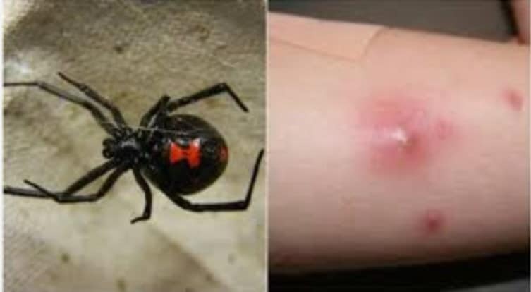 Τραγωδία: Πέθανε ο 48χρονος που τον είχε τσιμπήσει αράχνη – Είχε πάει διακοπές