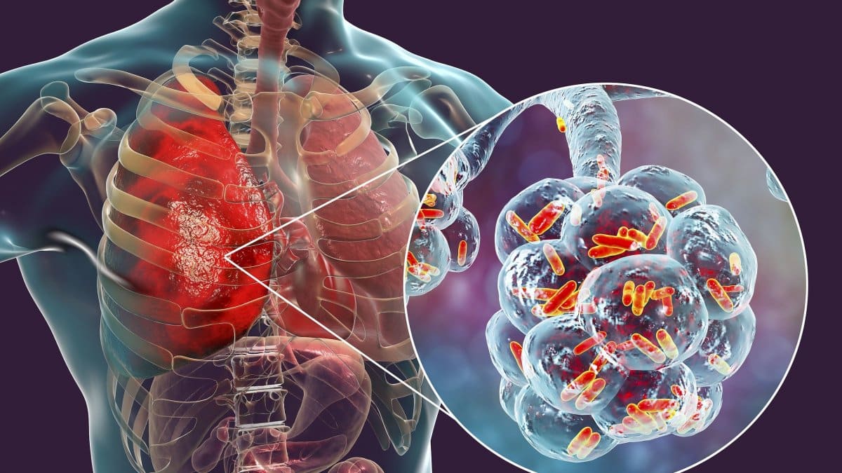 4d15614f bigstock bacterial pneumonia medical c 254466526