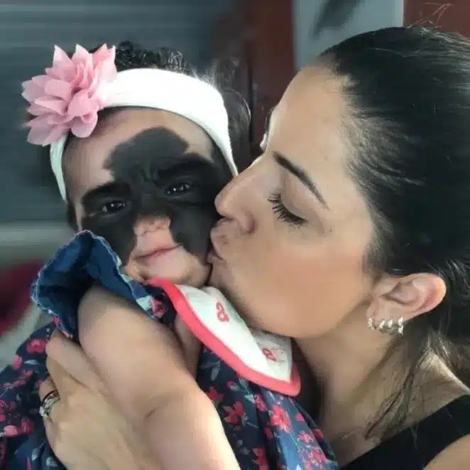 Η μικρή κορίτσι ονομάστηκε «Άσχημος Πάπιας» λόγω του σημαδιού της: Πώς φαίνεται μετά τις χειρουργικές επεμβάσεις; 1 scale 1200 2 768x767 1