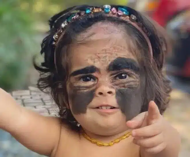 Η μικρή κορίτσι ονομάστηκε «Άσχημος Πάπιας» λόγω του σημαδιού της: Πώς φαίνεται μετά τις χειρουργικές επεμβάσεις; 2 scale 1200 3 768x637 1