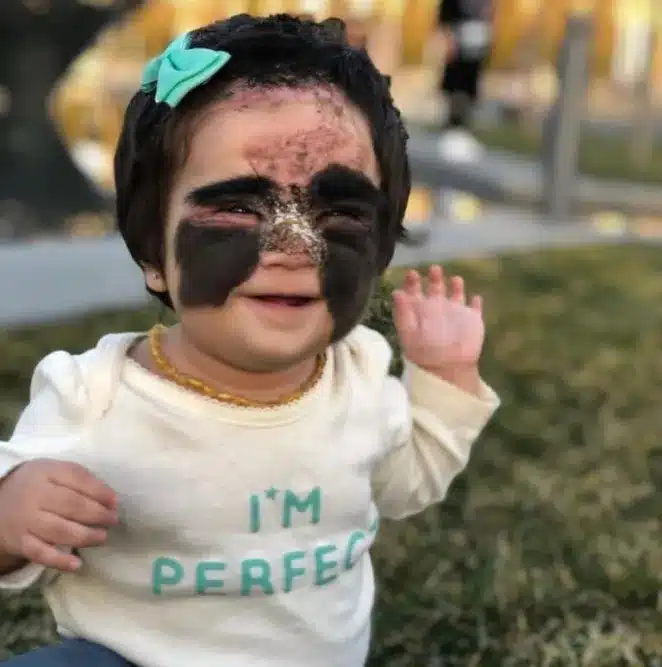 Η μικρή κορίτσι ονομάστηκε «Άσχημος Πάπιας» λόγω του σημαδιού της: Πώς φαίνεται μετά τις χειρουργικές επεμβάσεις; 3 scale 1200 4 768x774 1