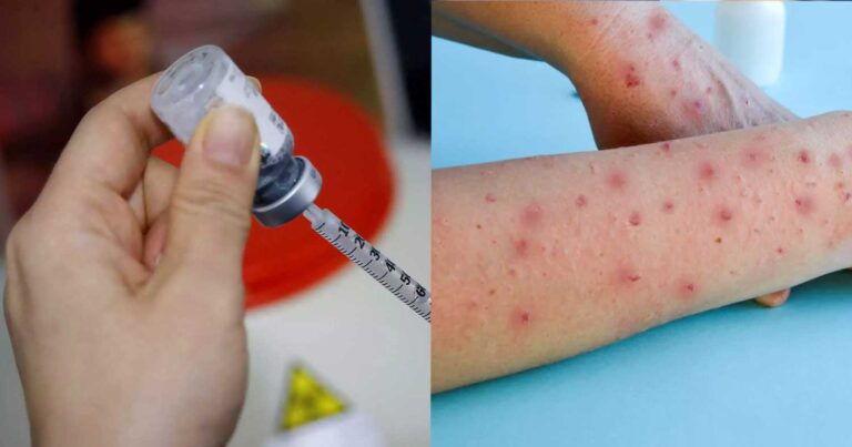 Διαθέσιμο από 22 Ιουλίου το εμβόλιο για την ευλογιά των πιθήκων στην Ελλάδα