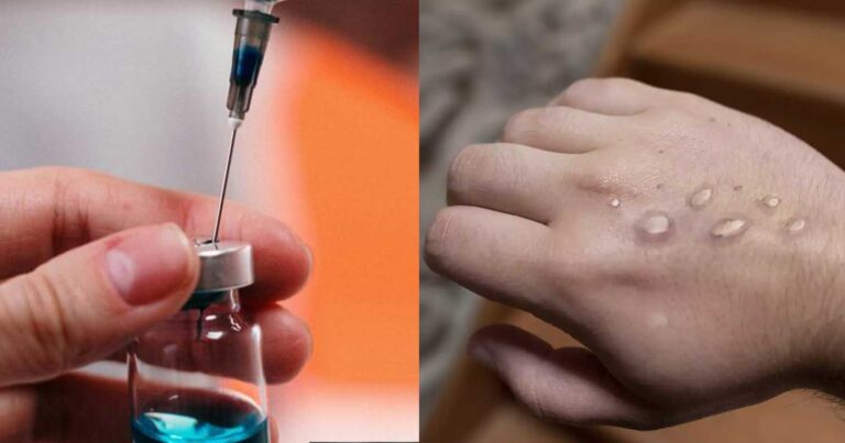 Σε ποιους συστήνεται το εμβόλιο για την ευλογιά των πιθήκων, πώς μεταδίδεται