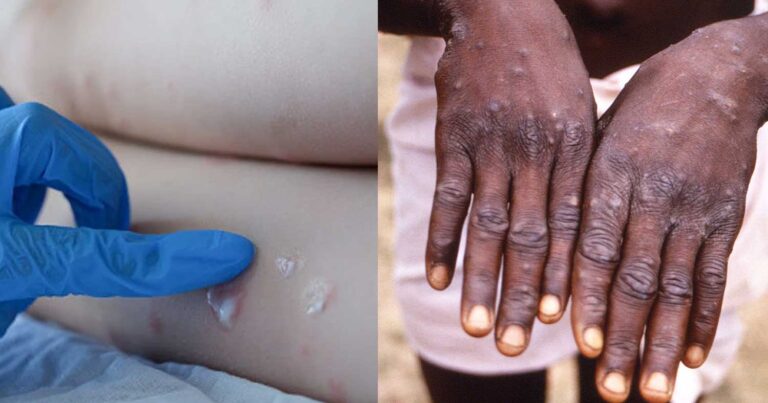 Πρώτο κρούσμα της Ευλογίας των Πιθήκων στην Ευρώπη