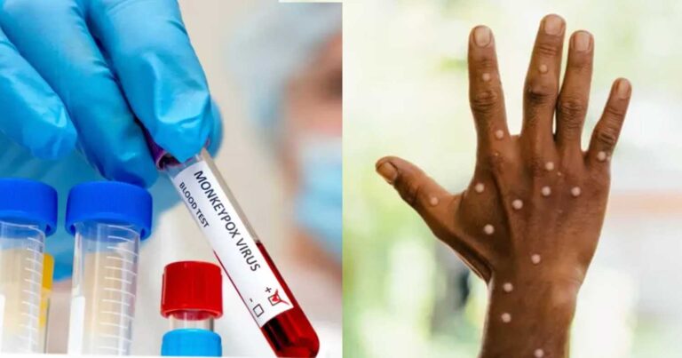 Συναγερμός στην Ευρώπη – Στη Σουηδία το πρώτο κρούσμα της Ευλογιάς των Πιθήκων