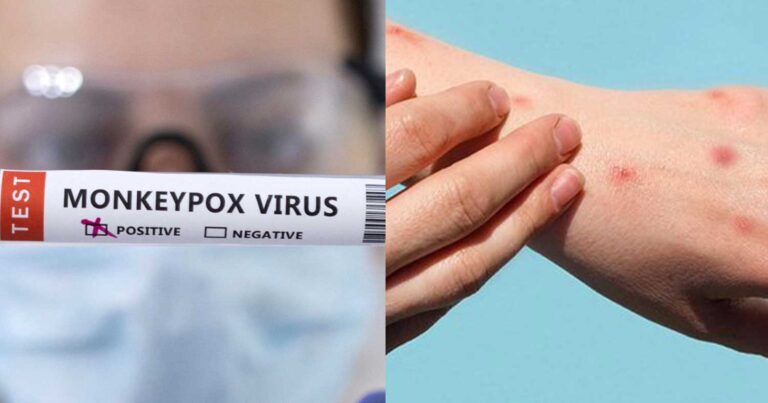 Ευλογιά των πιθήκων – Ανοίγουν πιο πολλά εμβολιαστικά κέντρα στην Ελλάδα