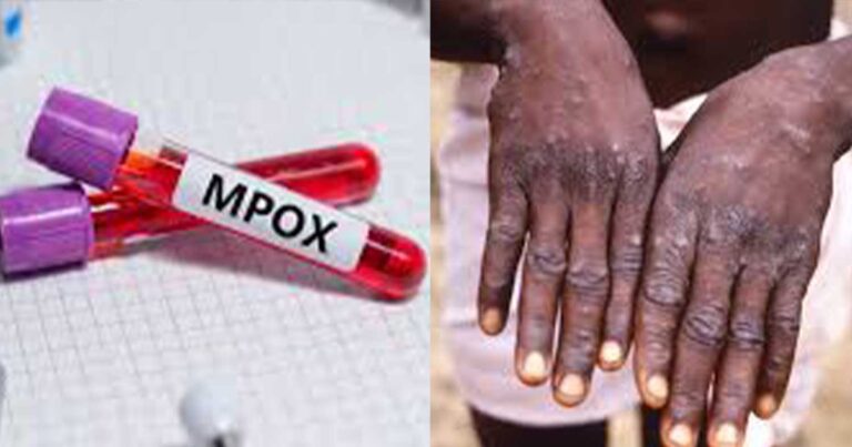 Ευλογιά των πιθήκων: Απέτυχε στις δοκιμές φάρμακο για το νέο στέλεχος – Τι θα γίνει