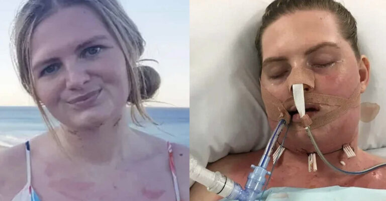 Από έναν χαλασμένο φρονιμίτη που δεν την πονούσε, παραλίγο να πεθάνει – Έπαθε σηψαιμία, τι συνέβη