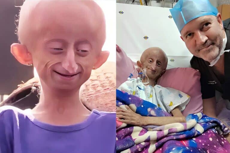 Πέθανε στα 19 το γενναίο κορίτσι που γερνούσε κατά 8 χρόνια σε 12 μήνες