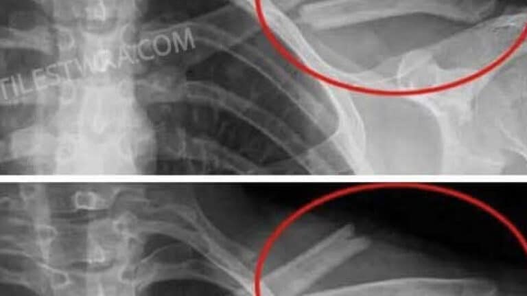 Auτό το ποτό θα καταστρέψει τα κόκαλα σας από μέσα αλλά όλοι το πίνουν