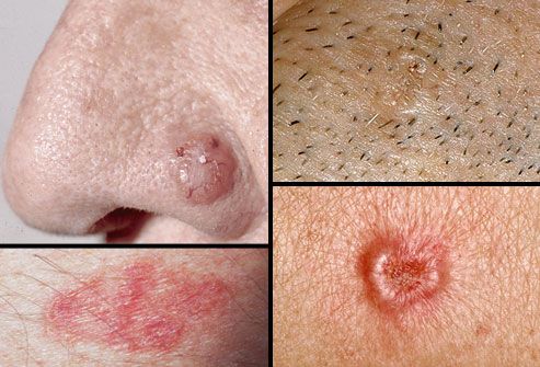 4basal cell carcinoma