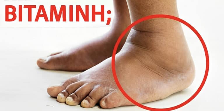 Αυτή η βιταμίνη αφαιρεί το πρήξιμο στα πόδια και τις γάμπες