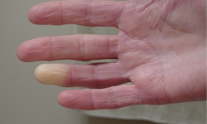 adult hand with raynauds syndrome picture id1031768438 666x399 1