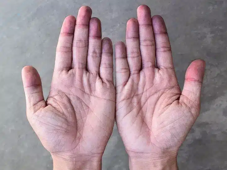 cyanotic hands blue hands thumbn
