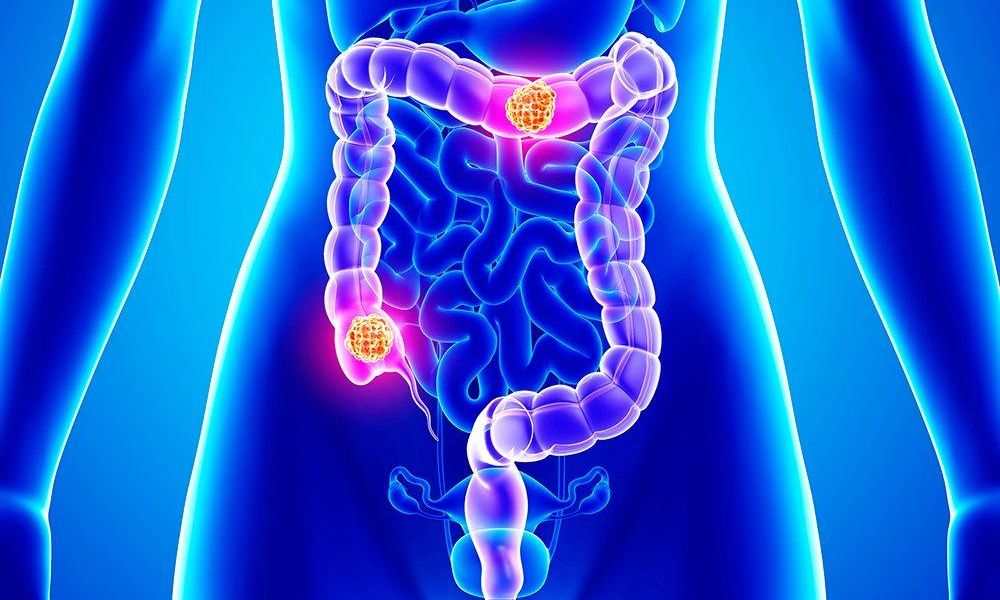 colon and rectal cancers
