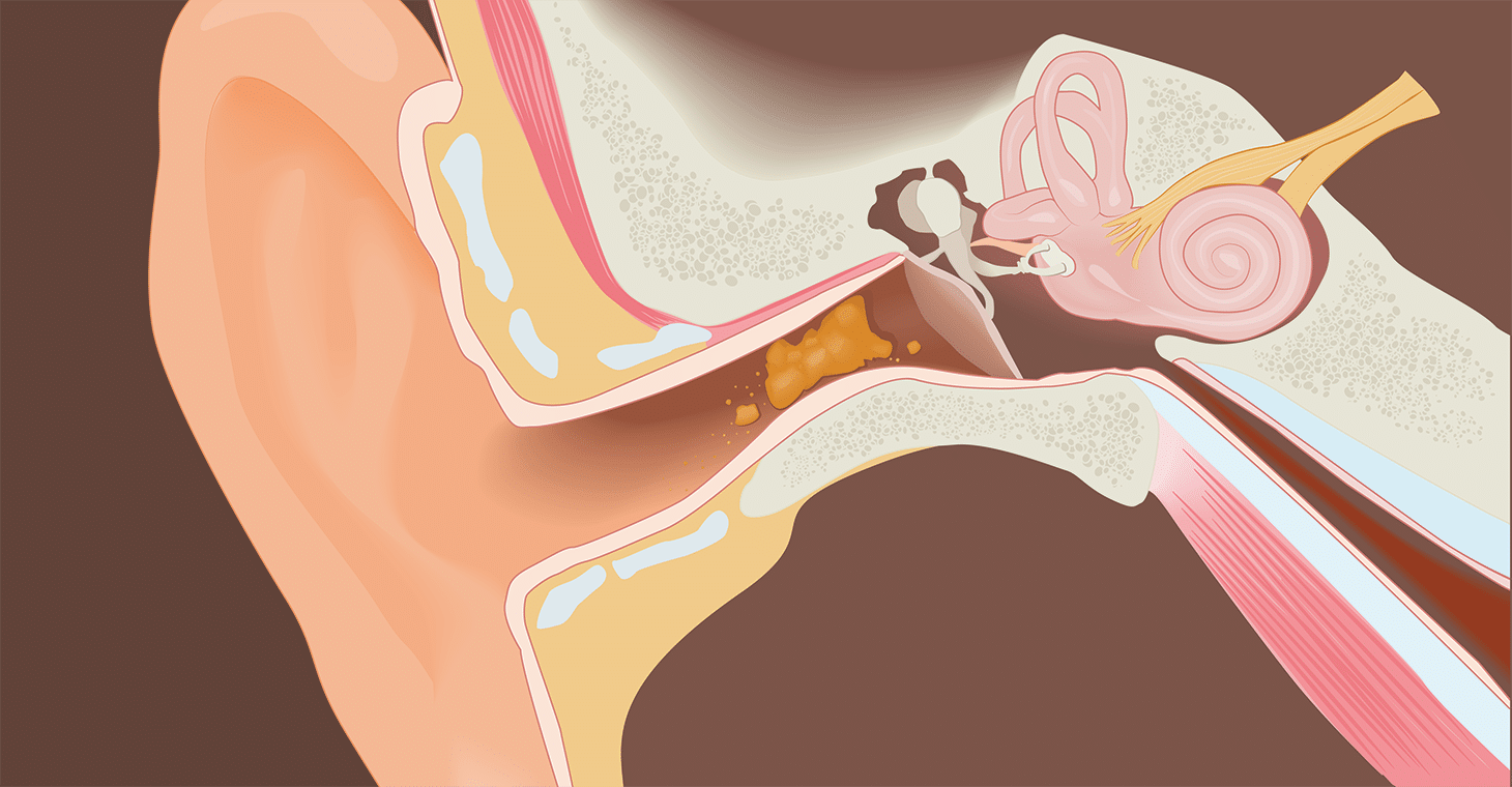 earwax in ear