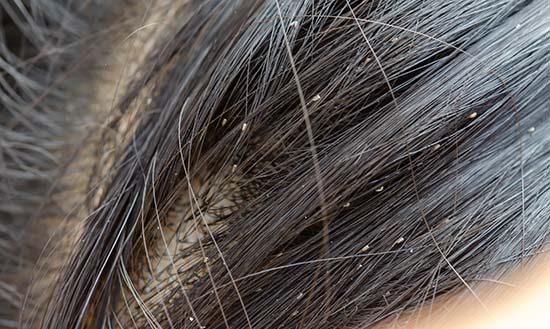 lice