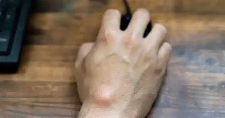 Μια κύστη στο πόδι ή τον καρπό: τι πρέπει να κάνετε;