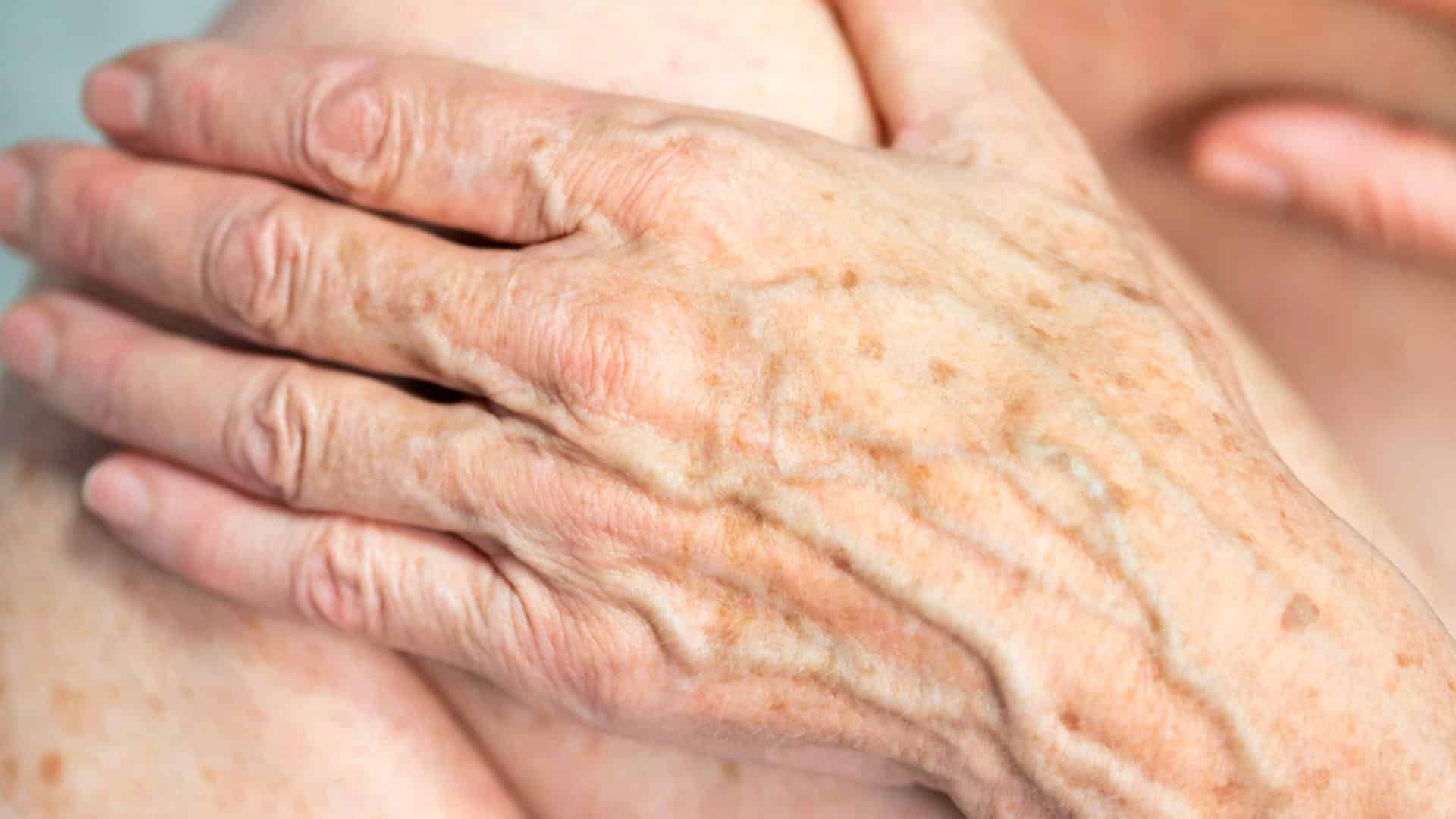 age spots hands