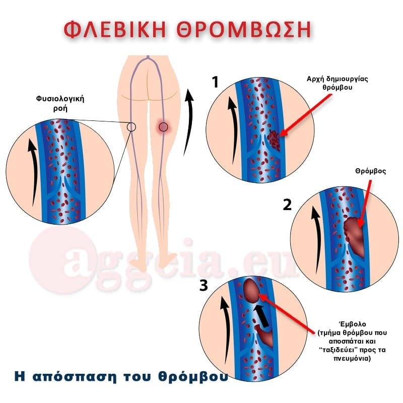 aggeia.eu deep vein thrombosis tzorbatzoglou ioannis