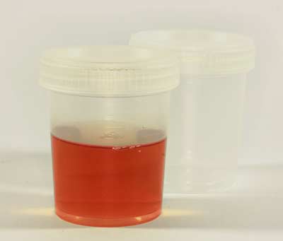 blood in urine hematuria