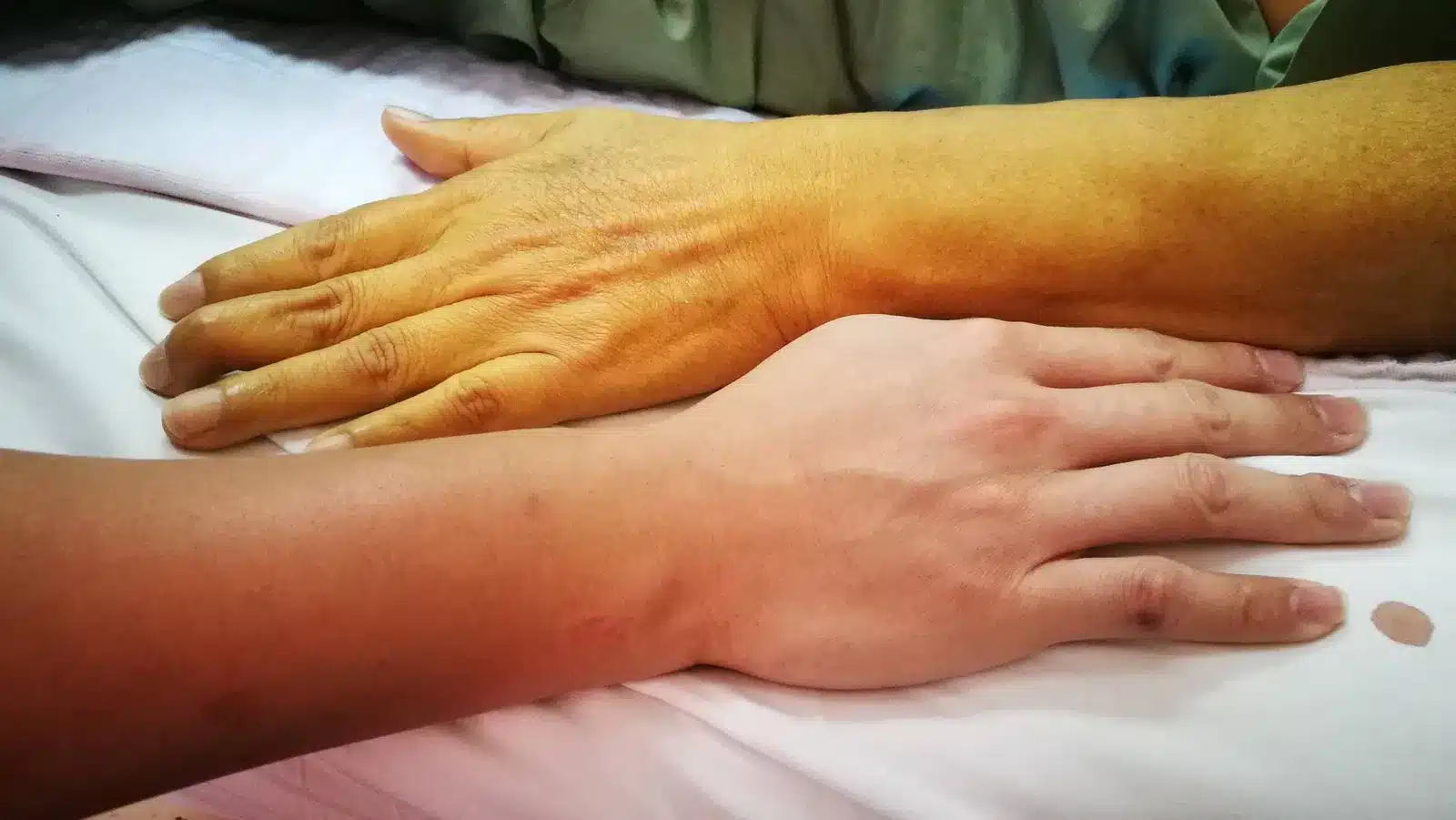 causes of jaundice yellow looking skin 1 scaled 1