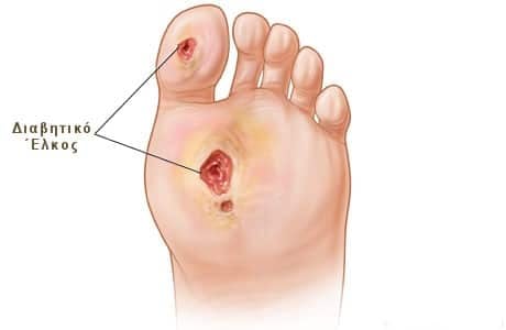 diabetic foot 1