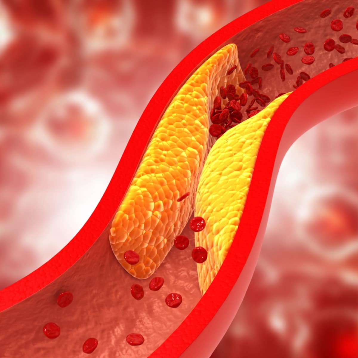 how to unclog arteries naturally