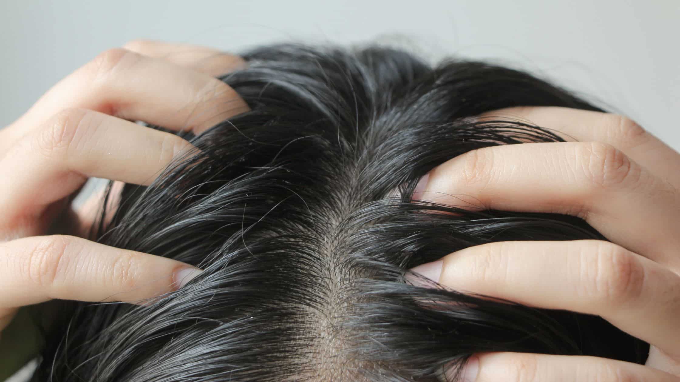 itchy scalp