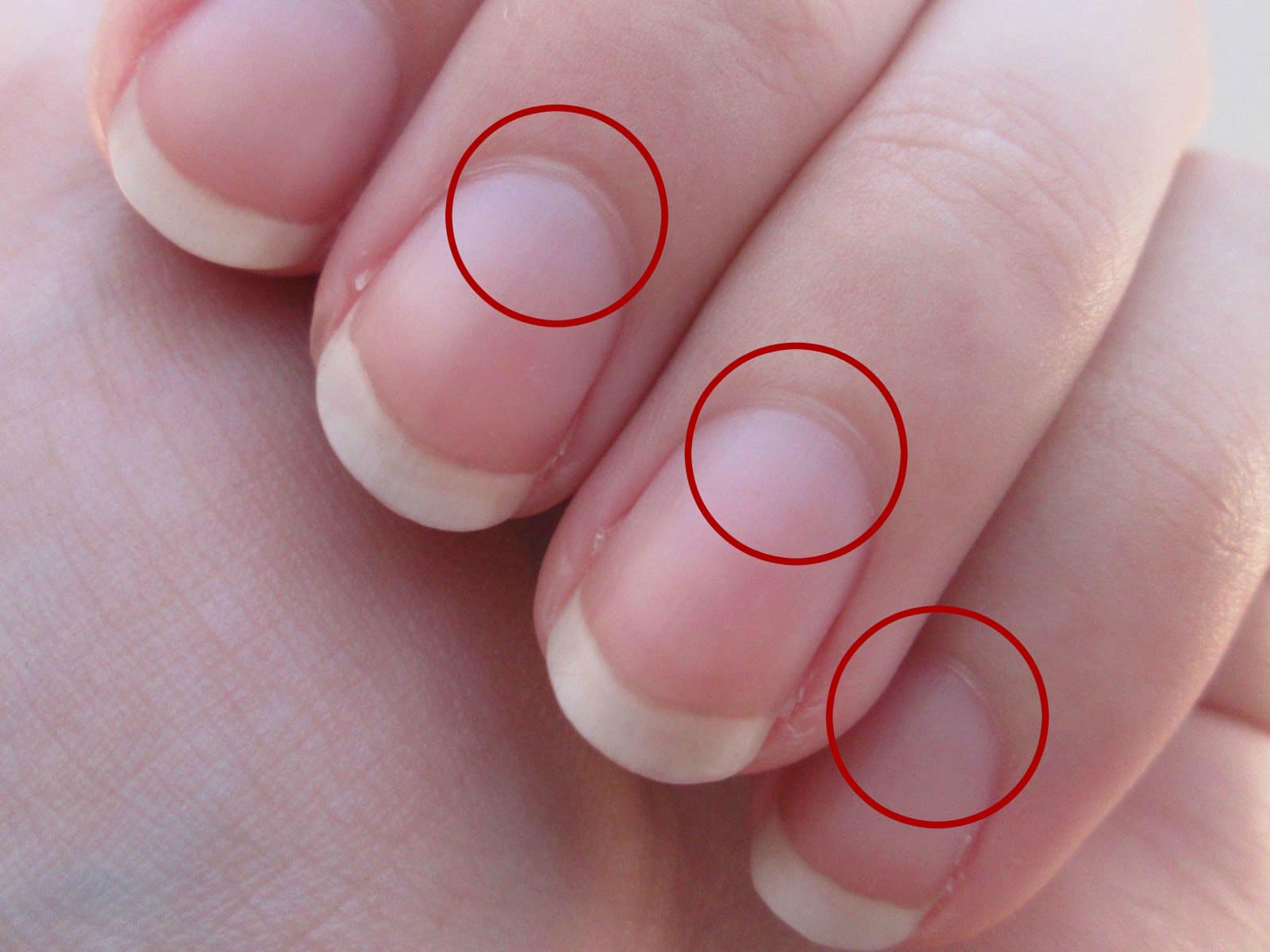 nails moons lack of lunula