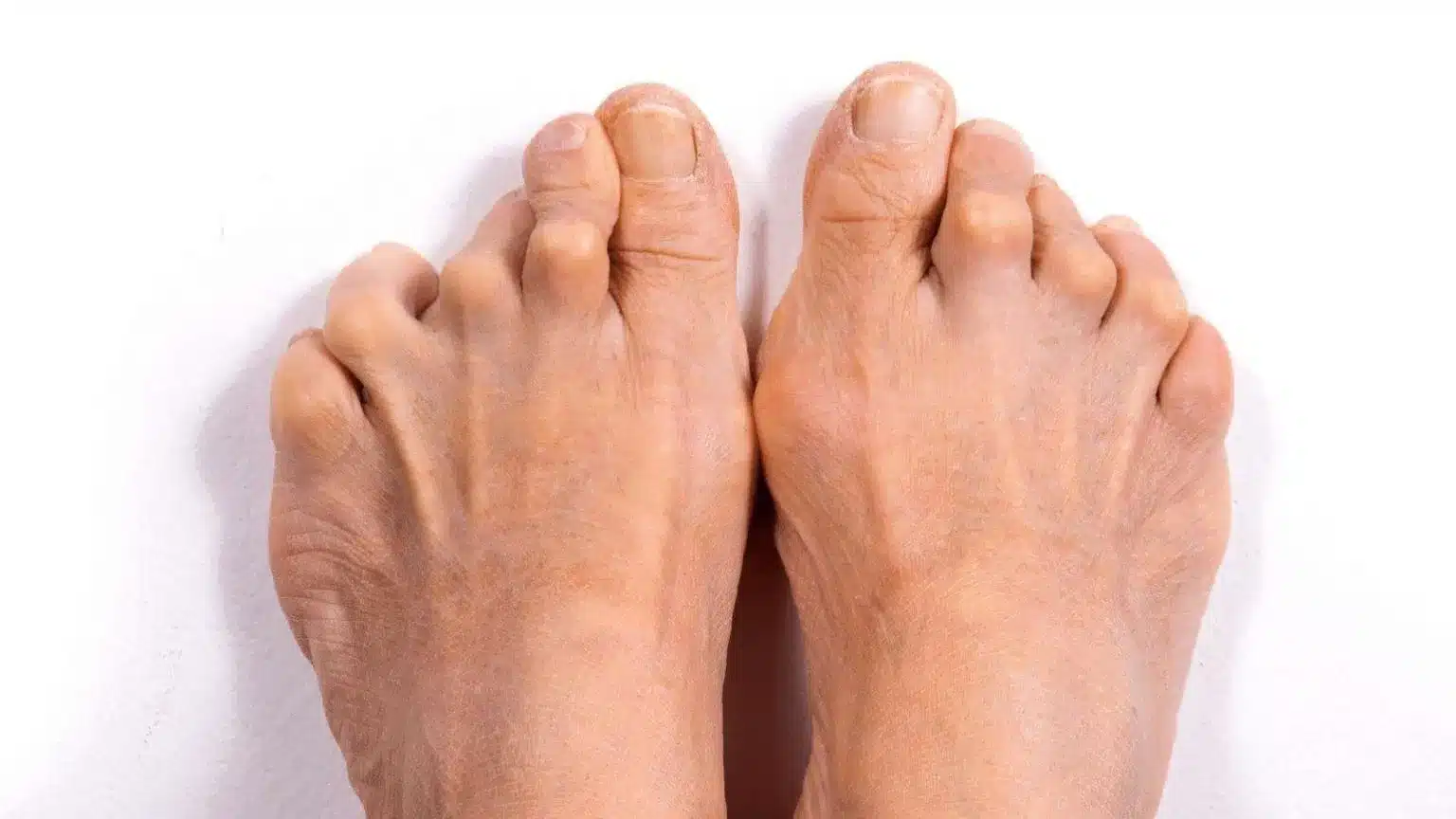 rheumatoid arthritis 1544x868a 1536x864 1